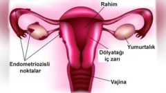 Endometriozis Nedir, Belirtileri Nelerdir?