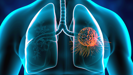 Akciğer Kanseri Nedir, Belirtileri ve Tedavi Yöntemleri