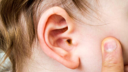 Orta Kulak İltihabı Nedir ve Tedavi Yöntemleri Nelerdir