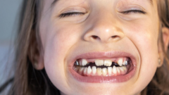 Çarpık Diş Nedir ve Tedavisi Nasıl Yapılır