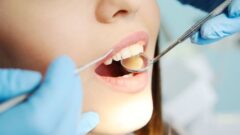 Diş Apsesi Nedir ve Nasıl Geçer