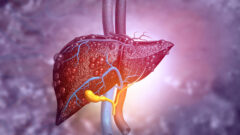 Yağlı Karaciğer Hastalığı Nedir Tedavisi